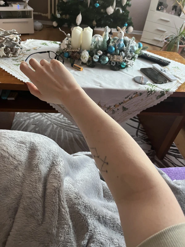 After 75% fading tattoo removal
