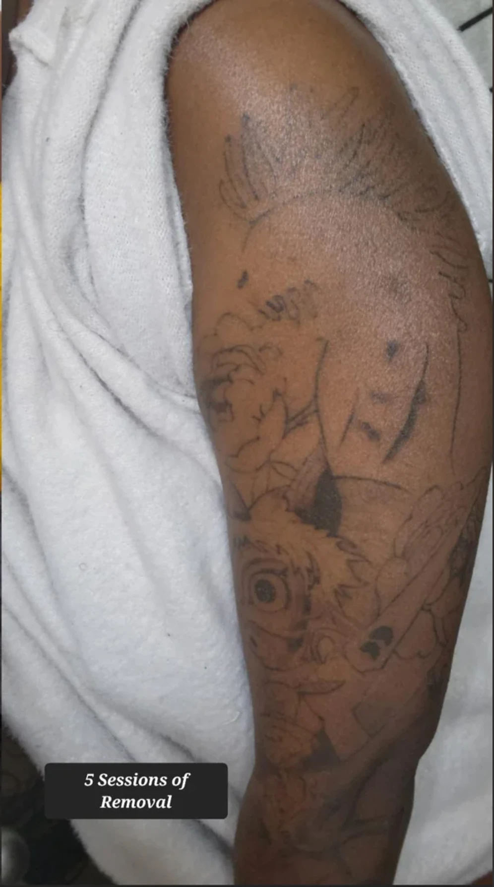 Large black arm tattoo fading after 5 sessions of PicoWay on Fitzpatrick Type V skin at Removery