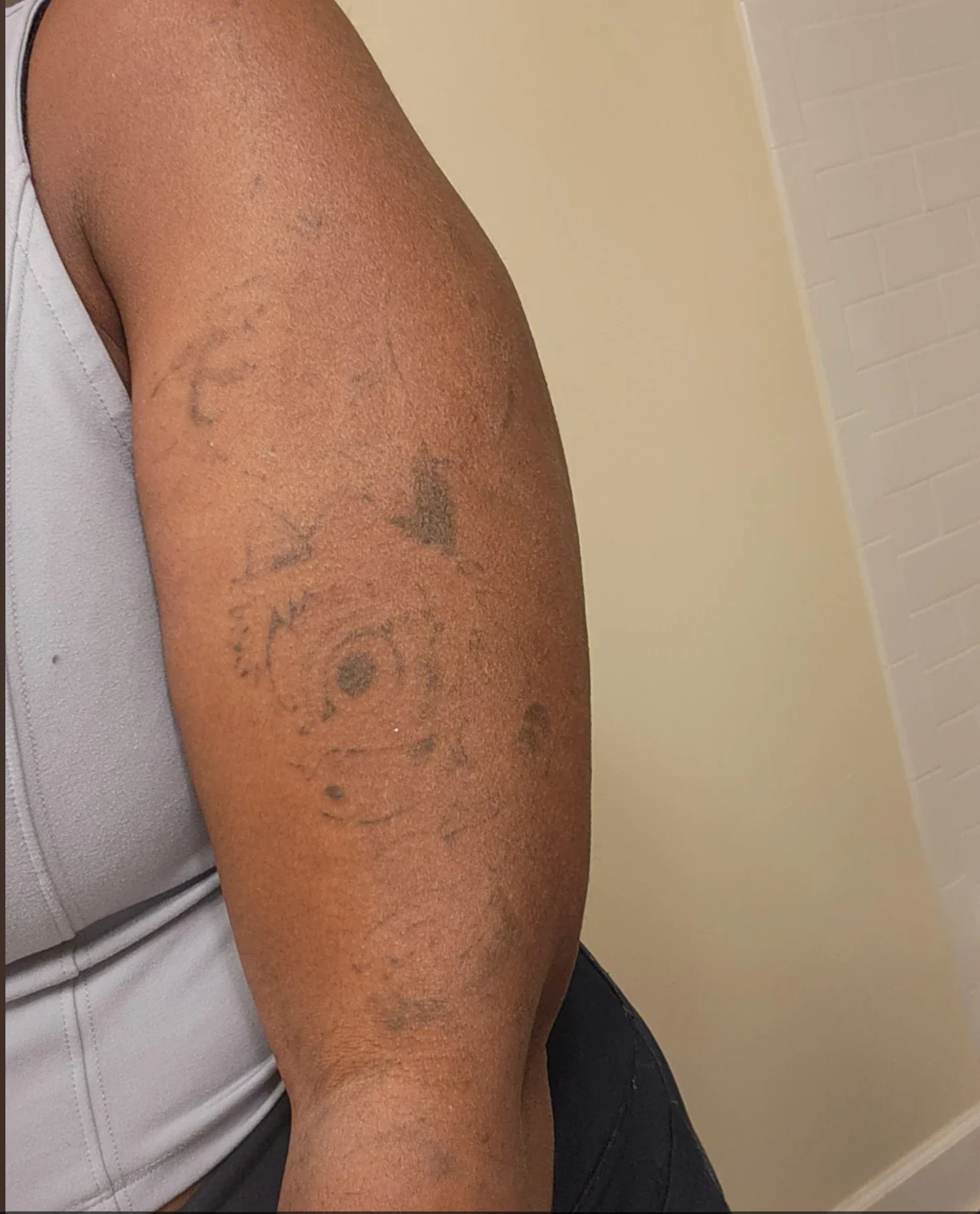 Large black arm tattoo 75% faded after 8 sessions of laser tattoo removal on dark skin