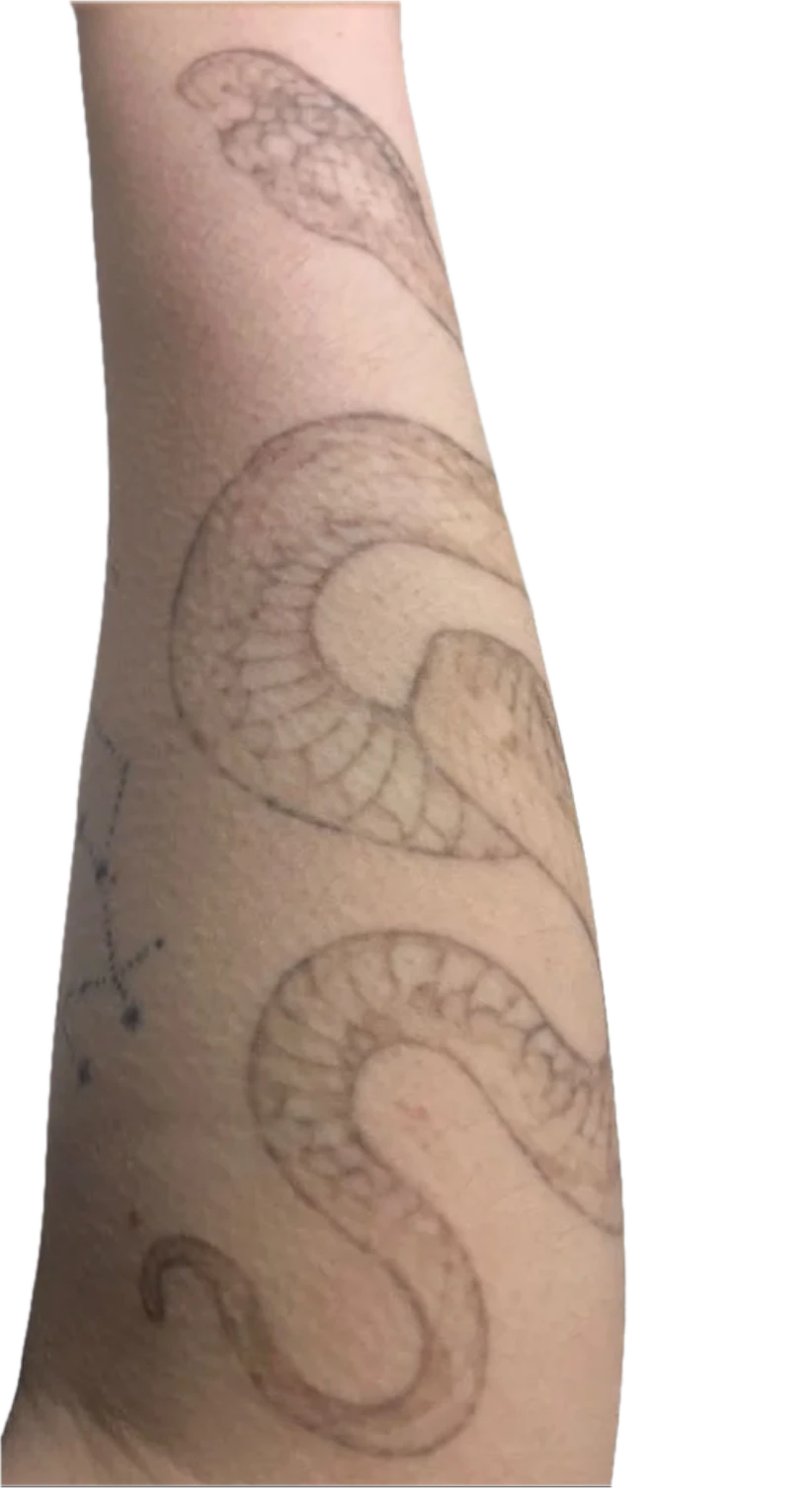 Black tattoo after 2 sessions