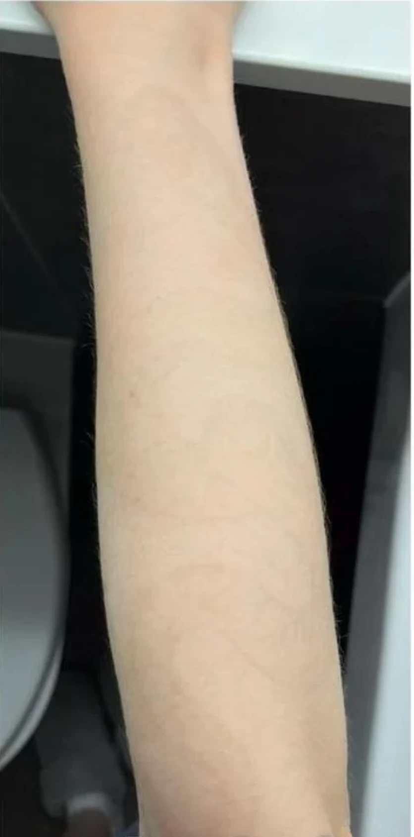 Medium Black Tattoo on the Forearm After 3 Sessions: Minimal Visible Change So Far (100% Fading)