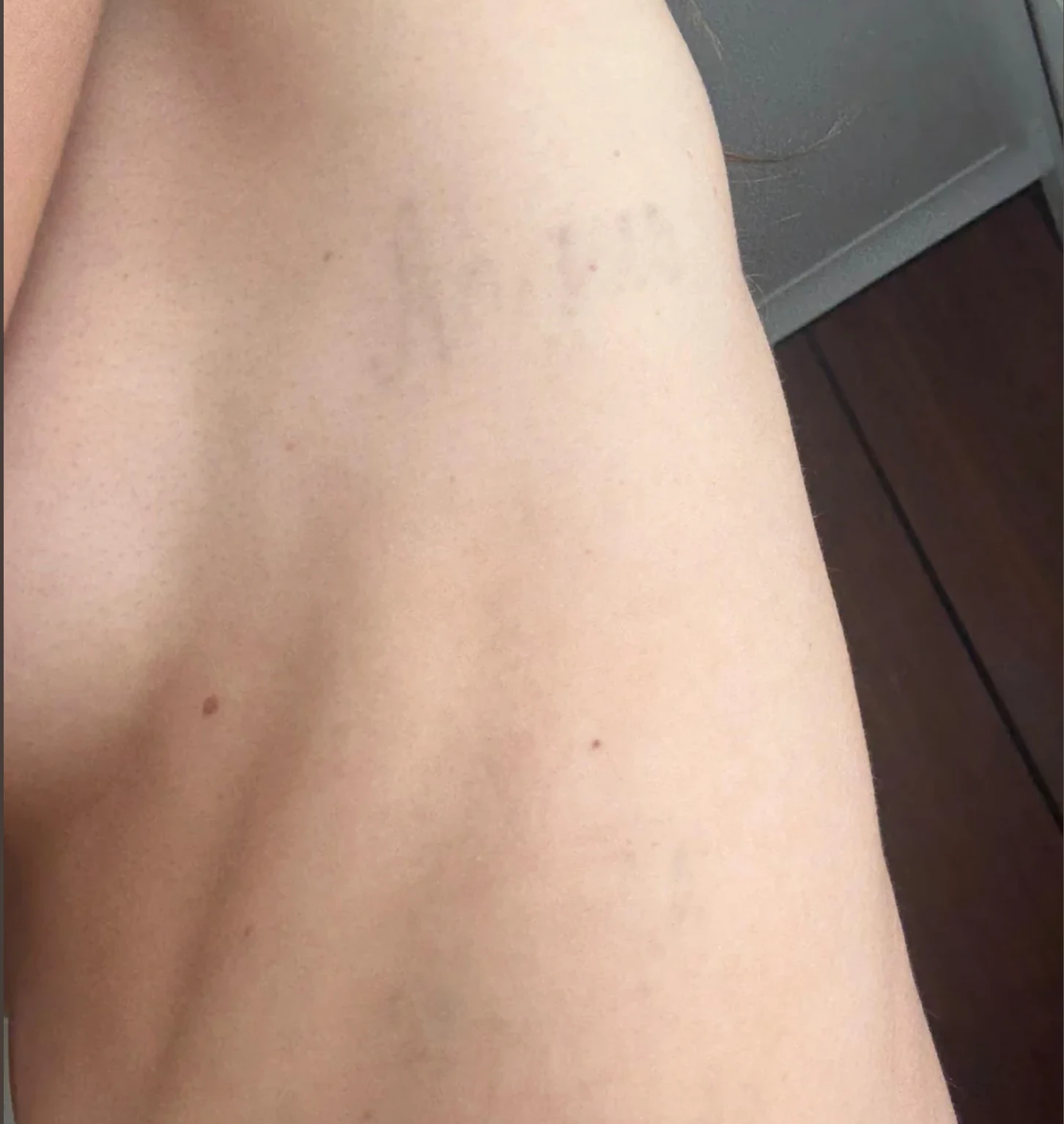 Small Black Tattoo on the Upper Arm After 3 Sessions: Minimal Visible Change So Far (100% Fading)