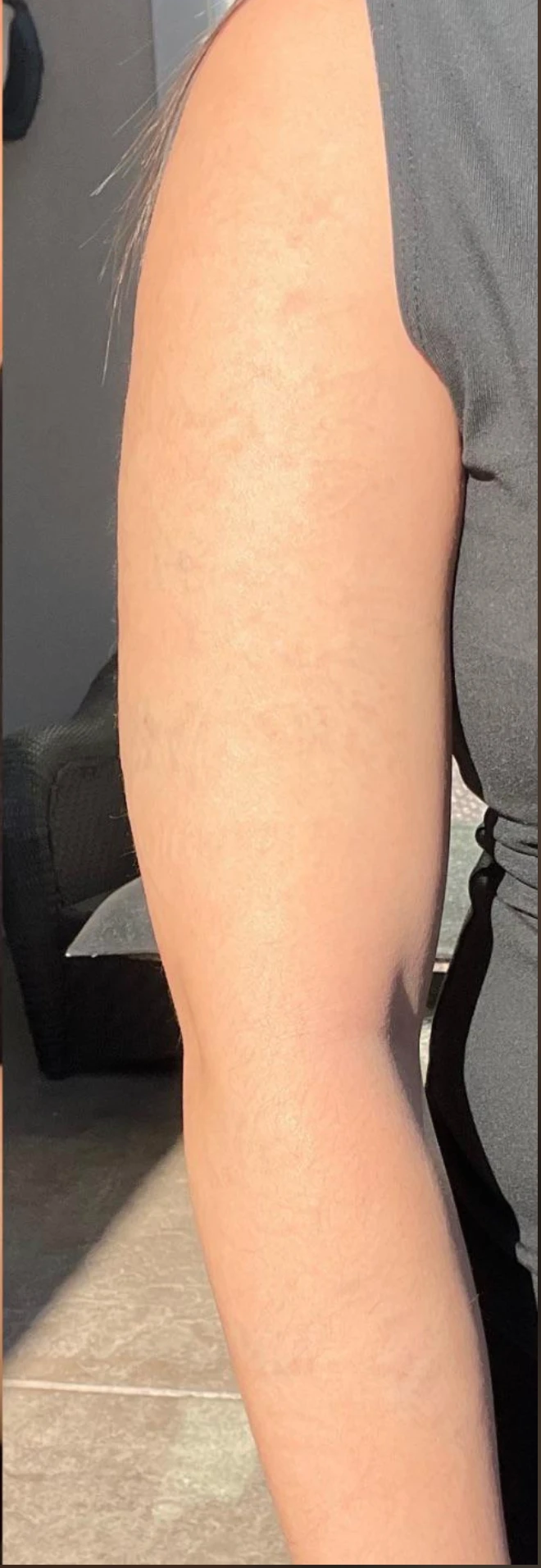 After cleared tattoo removal