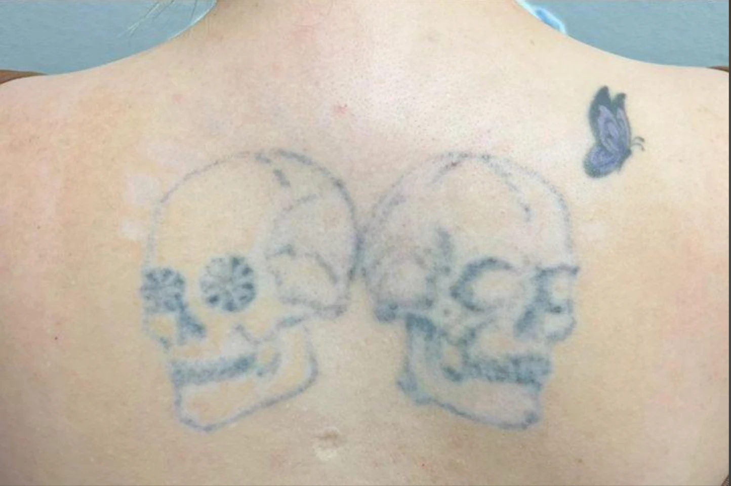 Black tattoo after 2 sessions