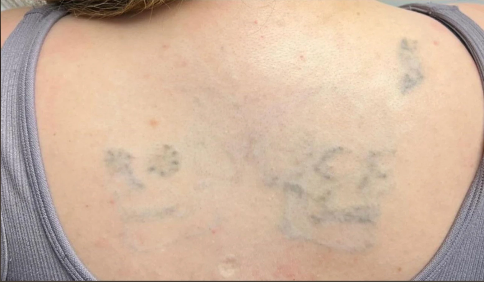 Large Black Tattoo on the Upper Back After 3 Sessions: Minimal Visible Change So Far (75% Fading)