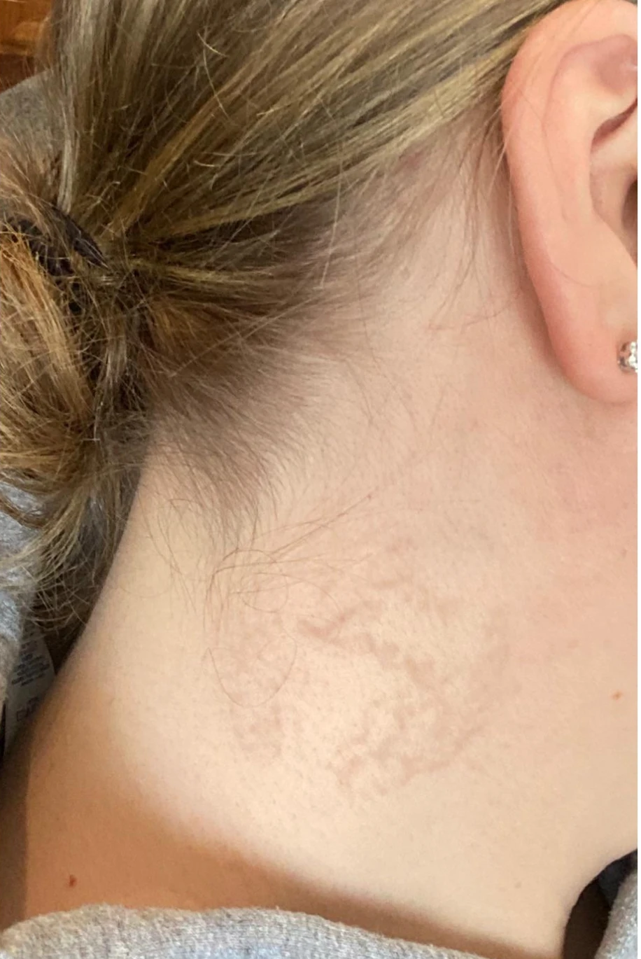 After 75% fading tattoo removal