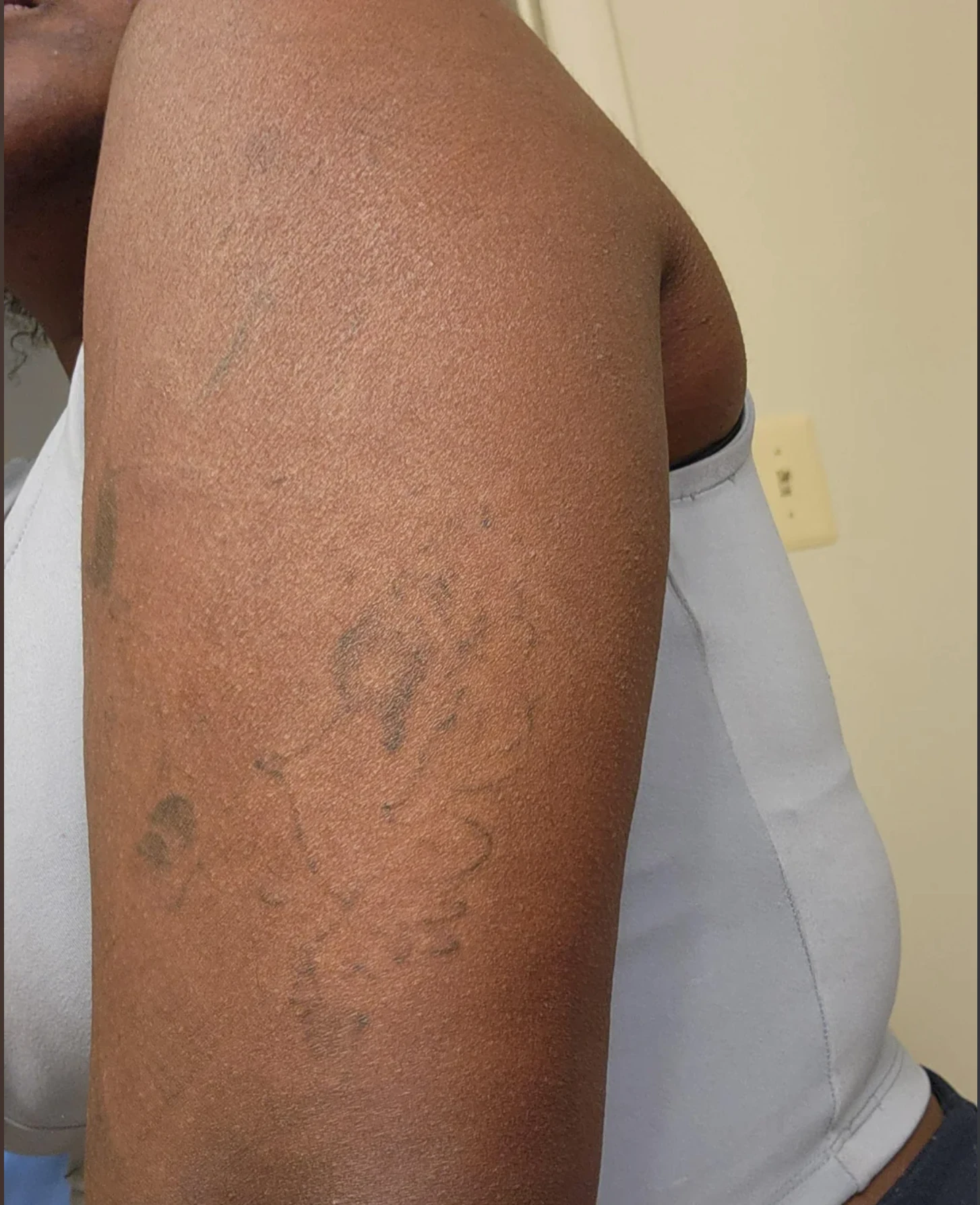 After 75% faded tattoo removal