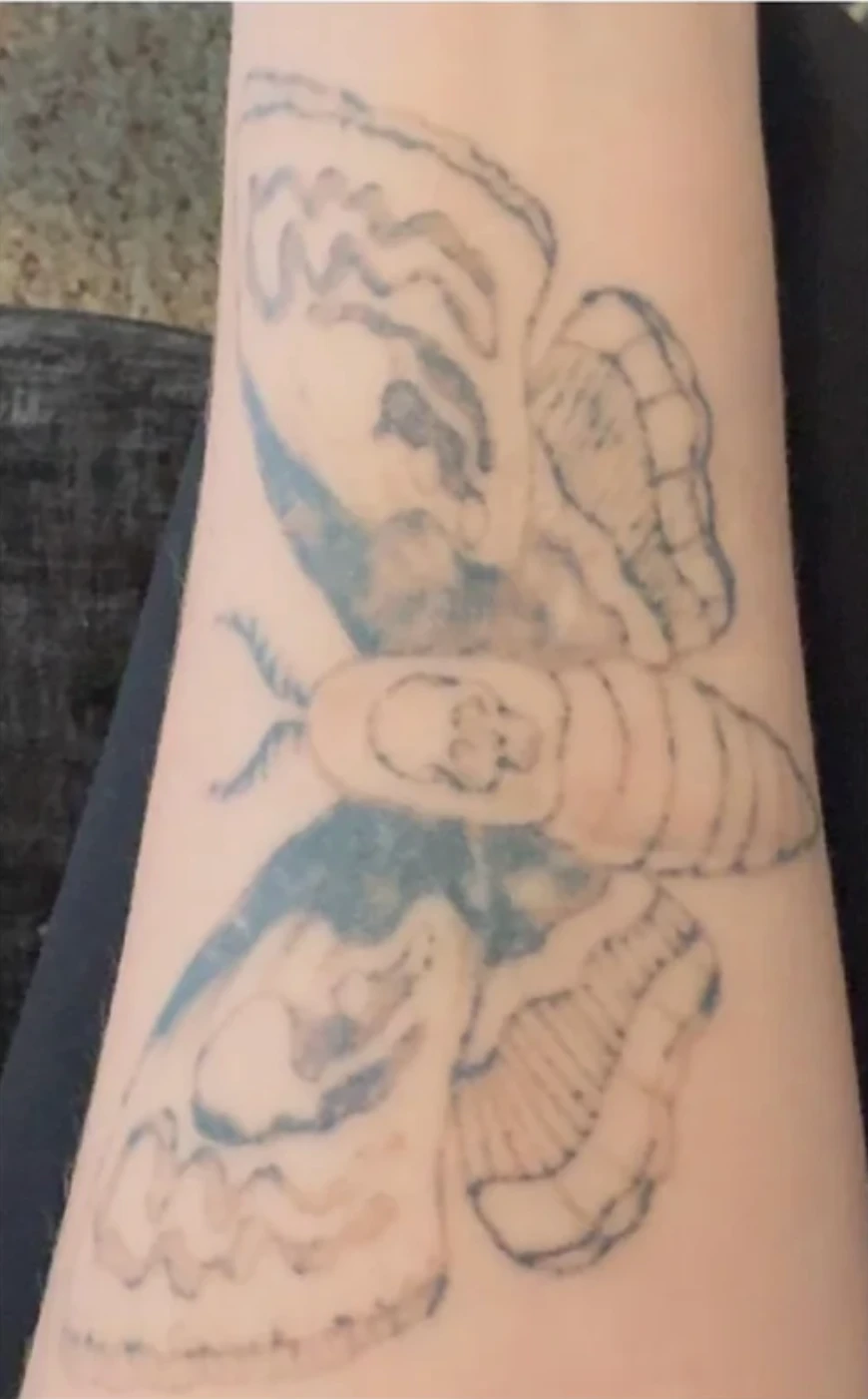 Small Black Tattoo on the Forearm After 4 Sessions: Minimal Visible Change So Far (50% Fading)