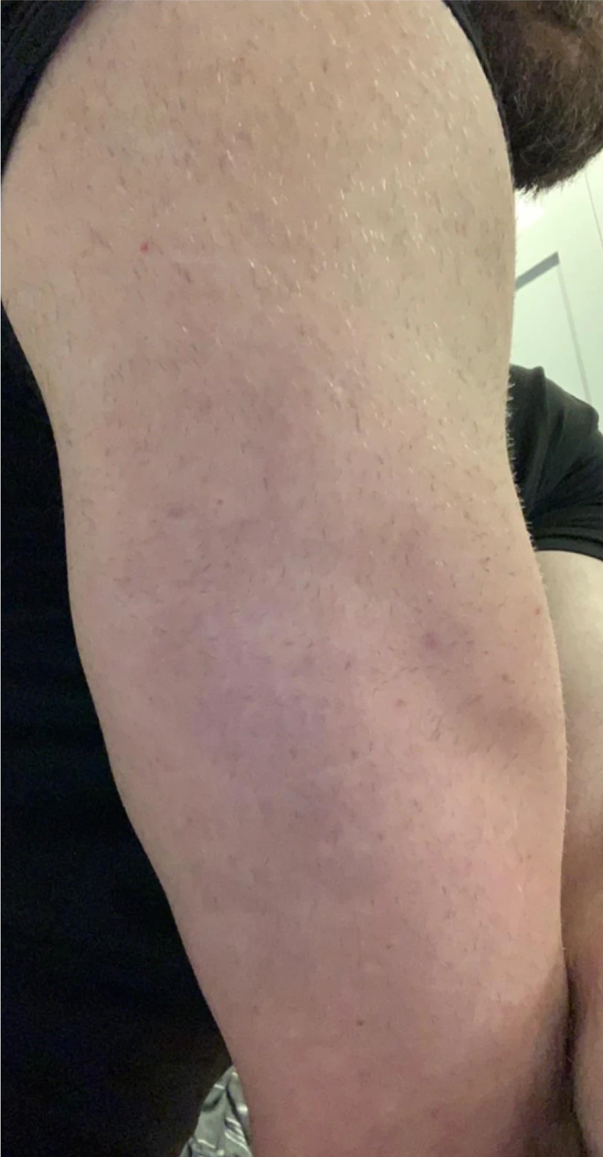 After complete removal tattoo removal