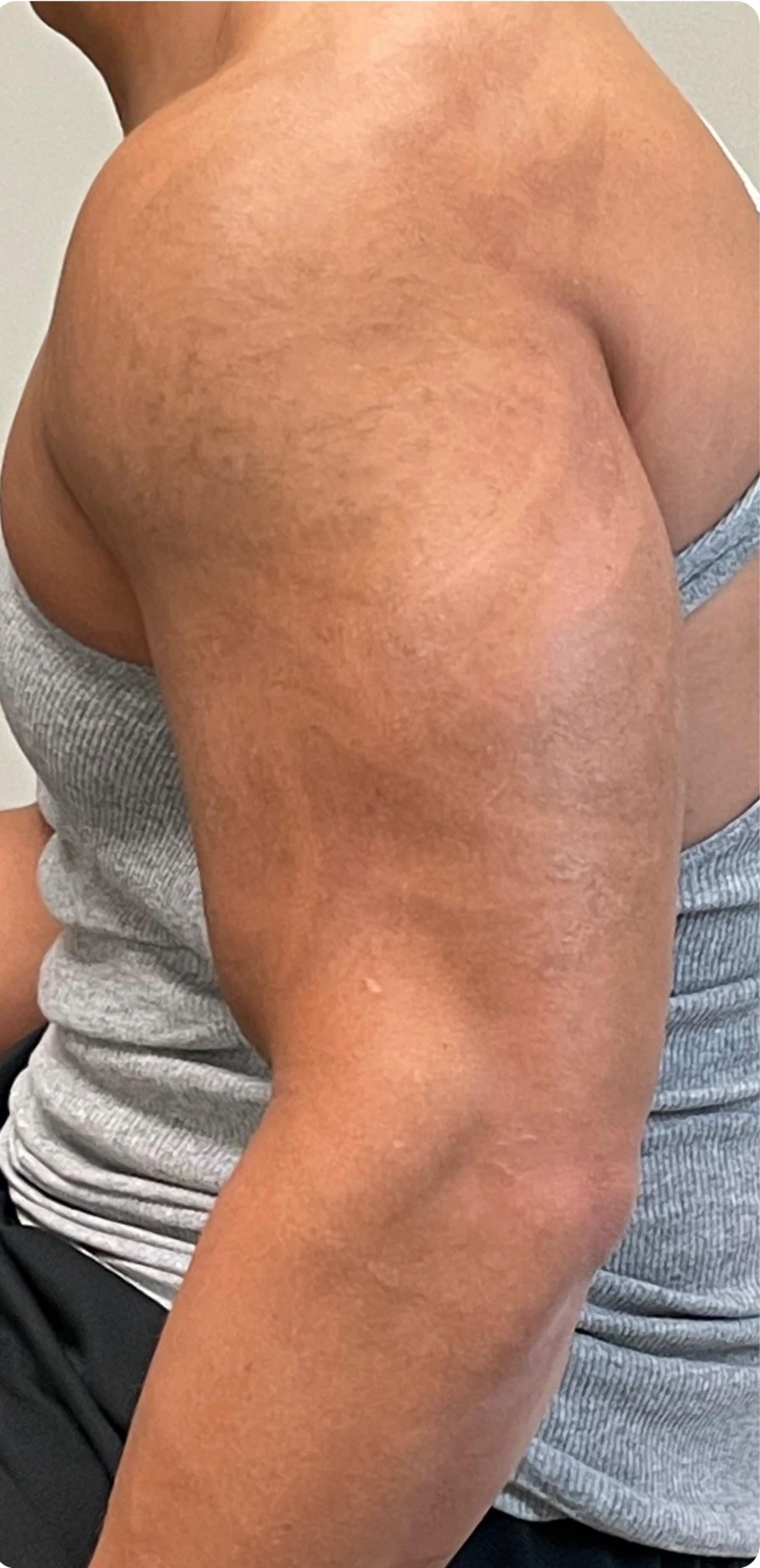 Black tattoo after 7 sessions