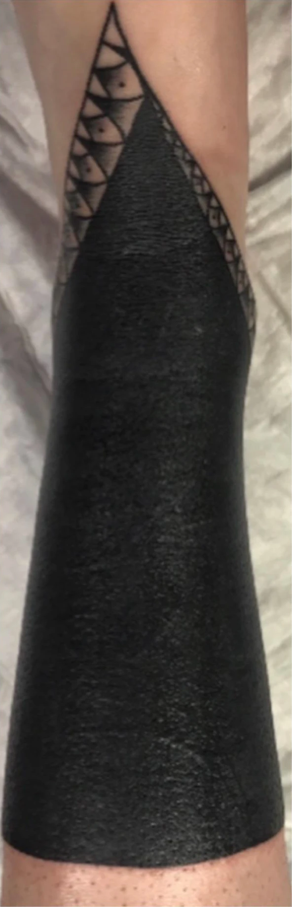 black tattoo before laser removal
