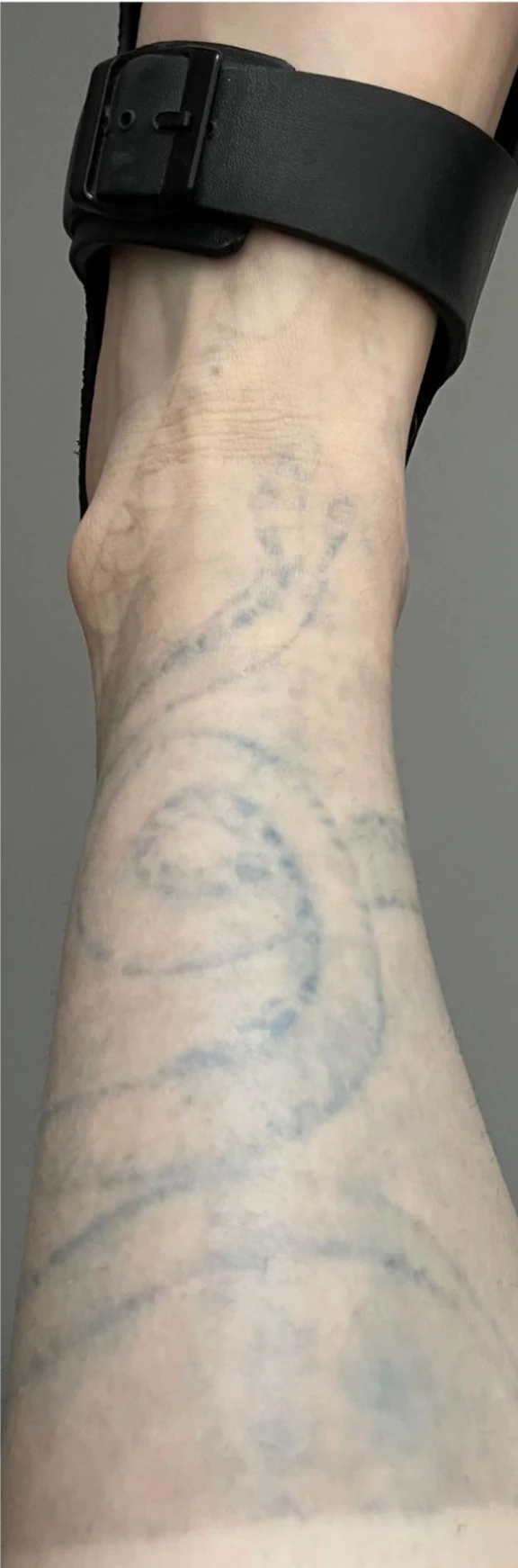 black tattoo after 15 sessions