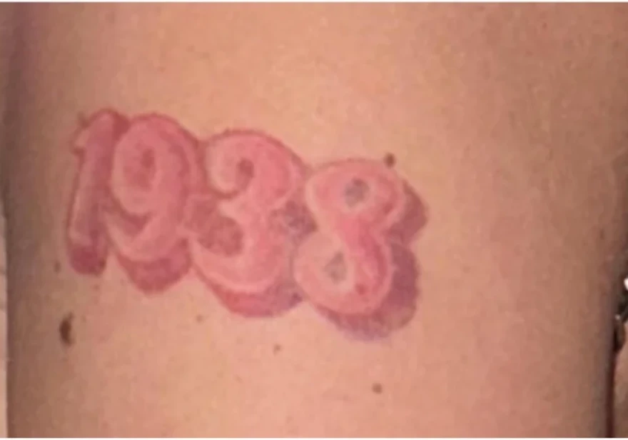 Red and White tattoo removal before and after 5 sessions photo
