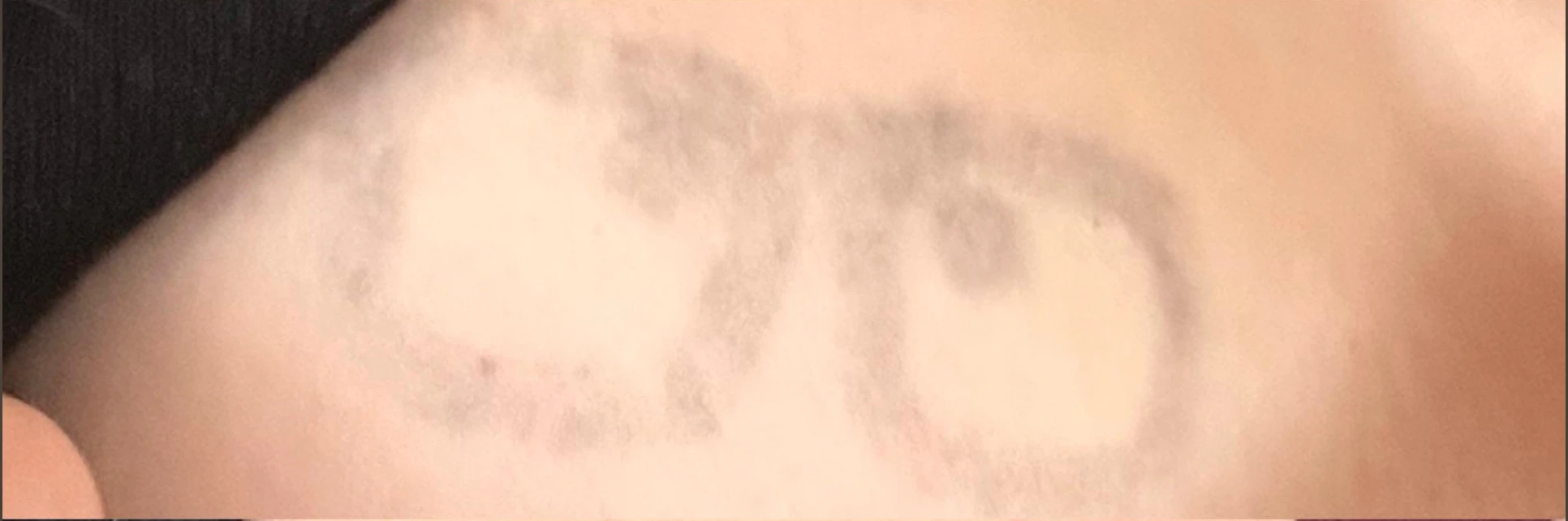 Black shoulder tattoo fading after 4 sessions of laser tattoo removal