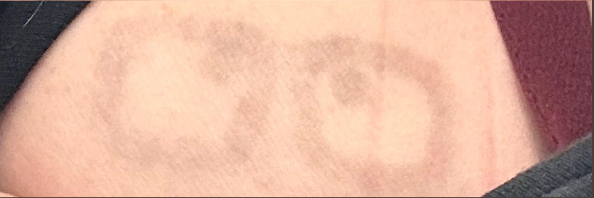 Black shoulder tattoo 75% faded after 5 sessions with PicoWay and Quanta Q-Plus C