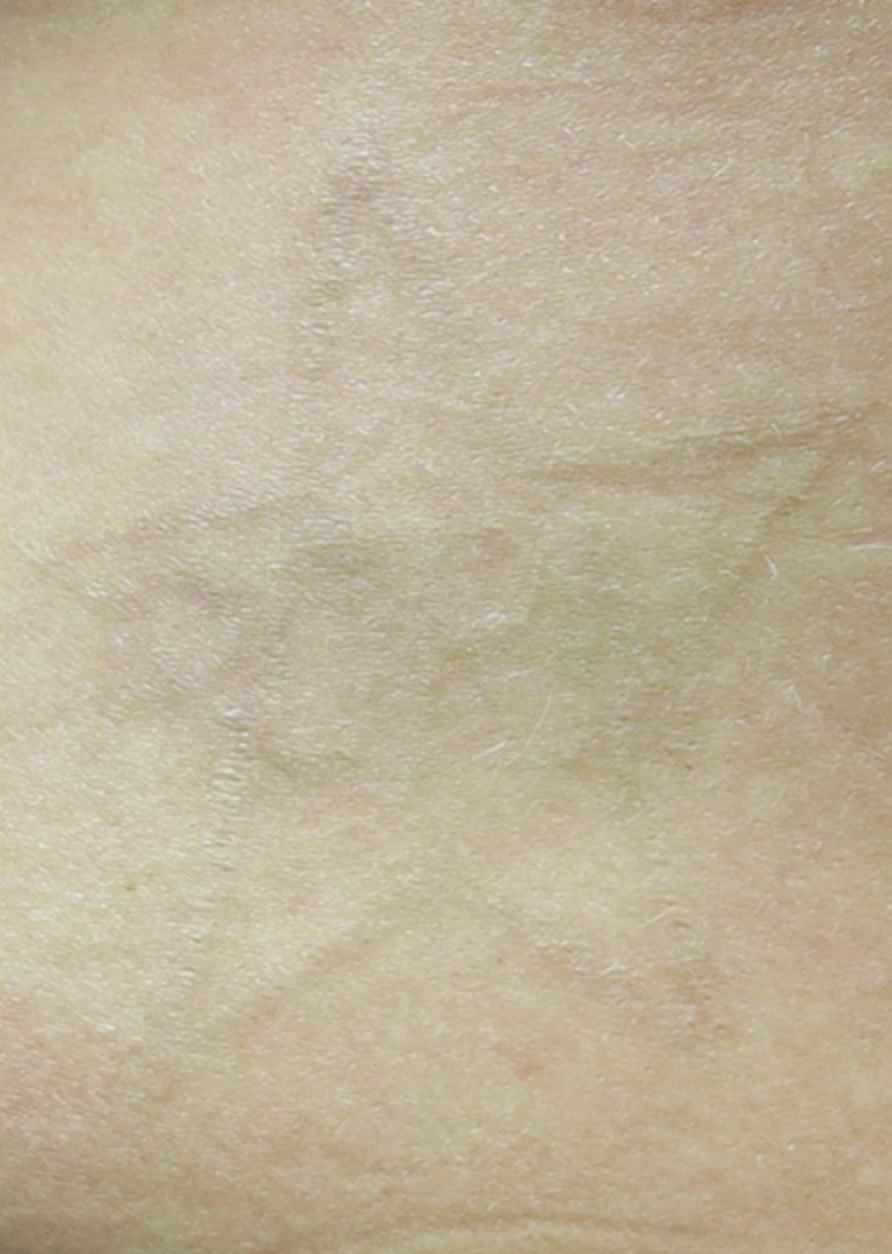 Black tattoo after 8 sessions