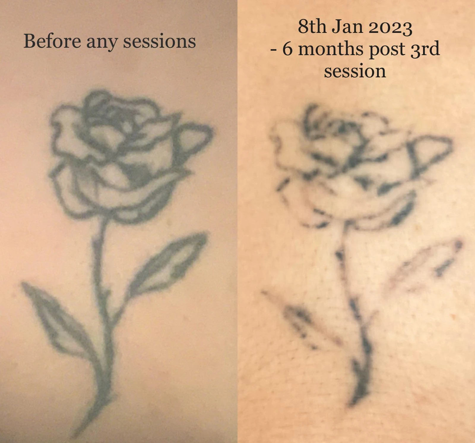 black tattoo before laser removal