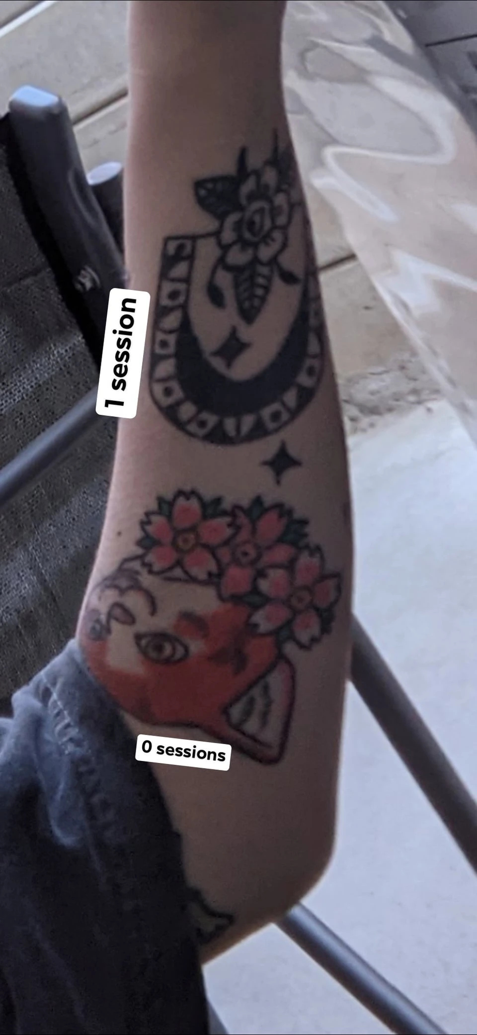 white tattoo before laser removal