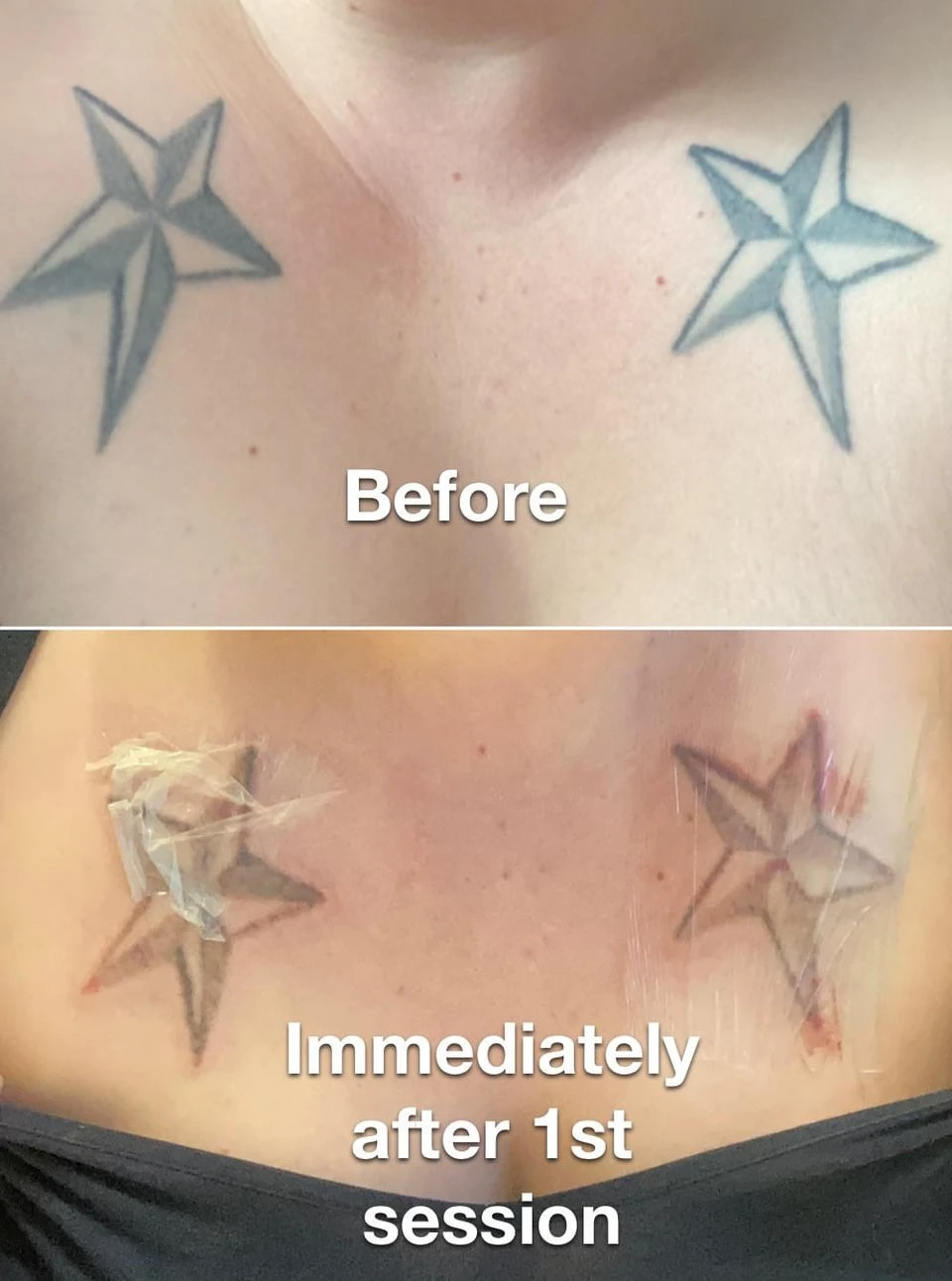 black tattoo before laser removal