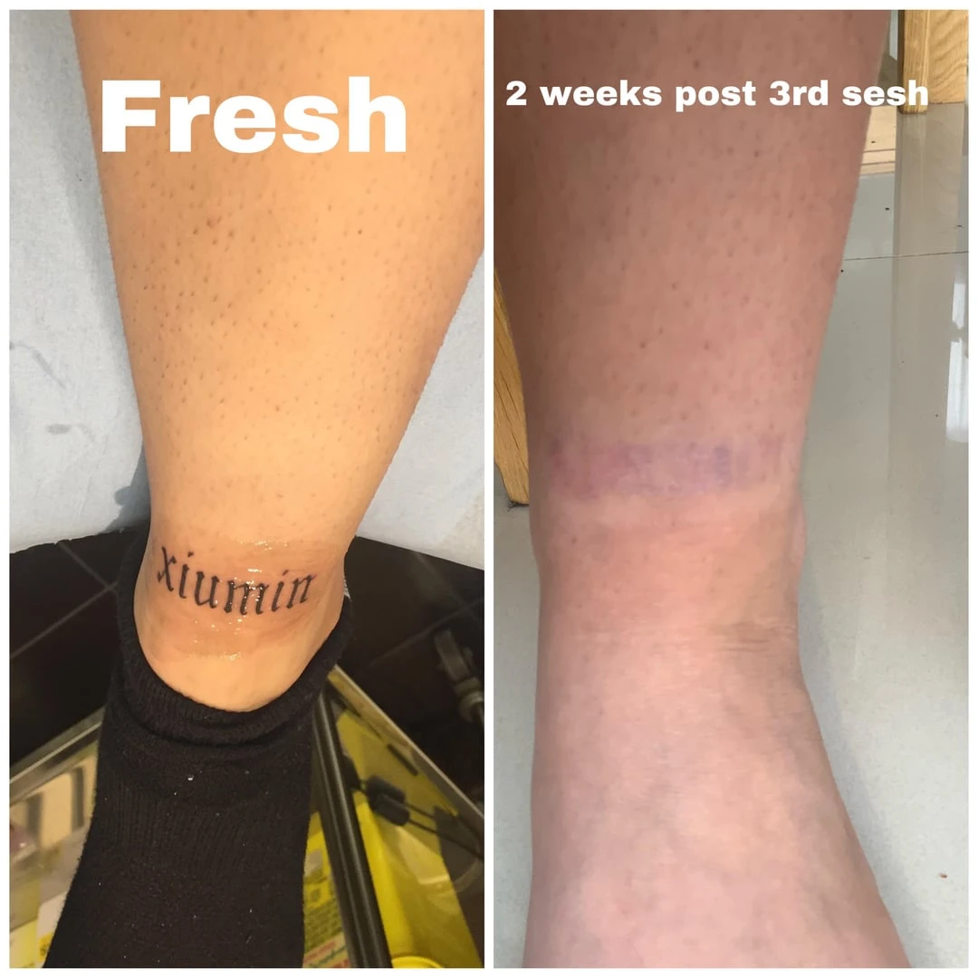 black and red tattoo after 3 sessions