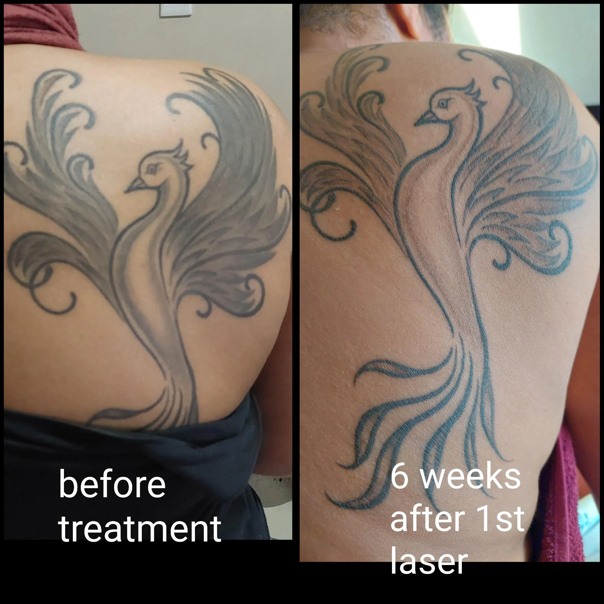 black and white tattoo before laser removal