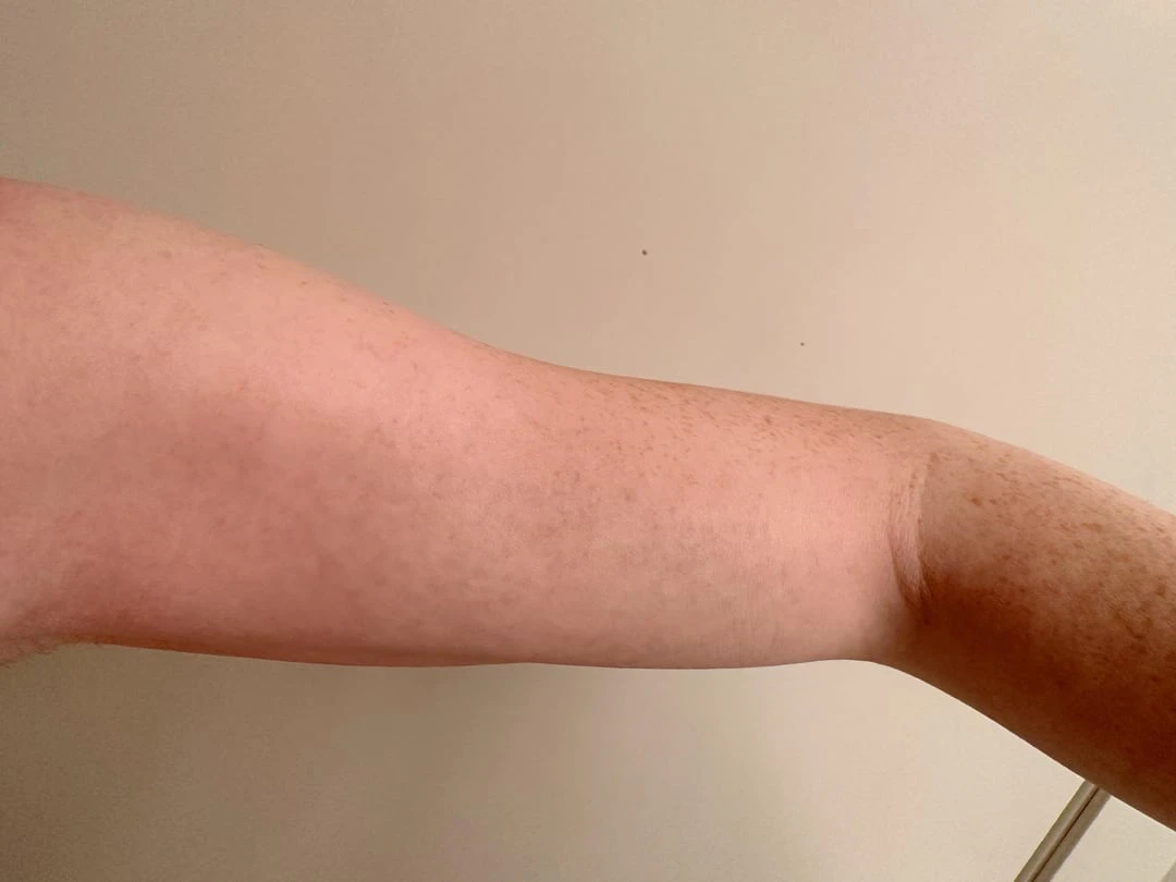 Black tattoo after 6 sessions