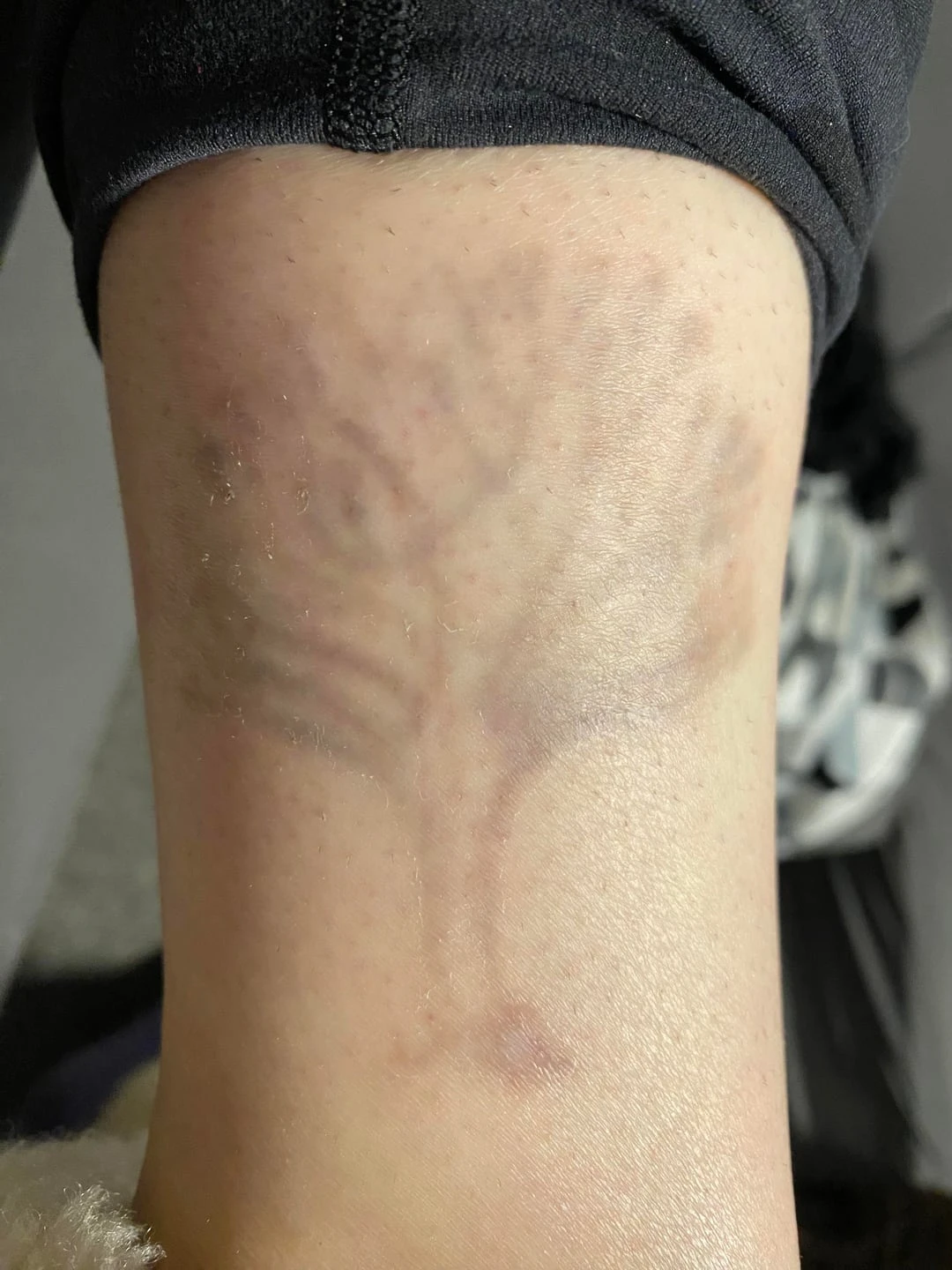 black tattoo before laser removal