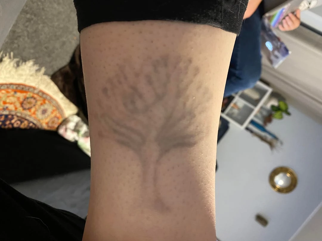 black tattoo after 1 sessions
