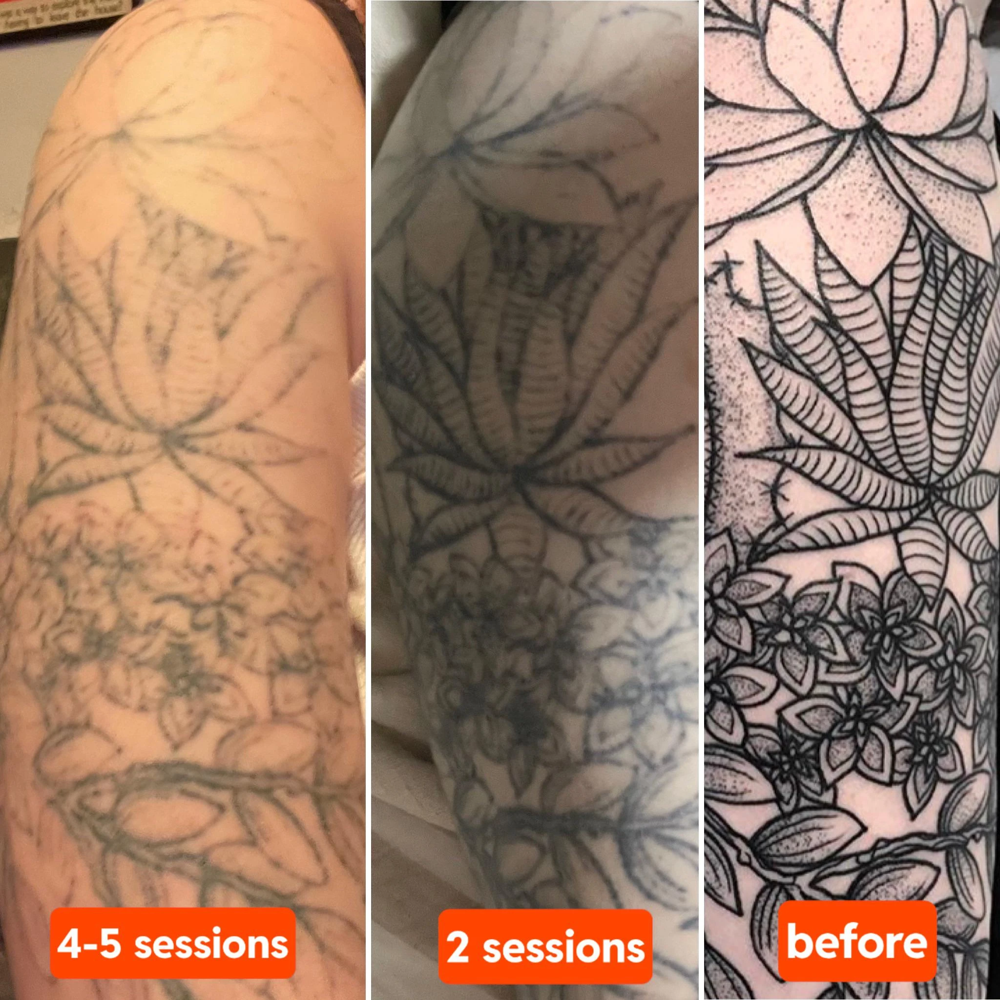 black tattoo before laser removal