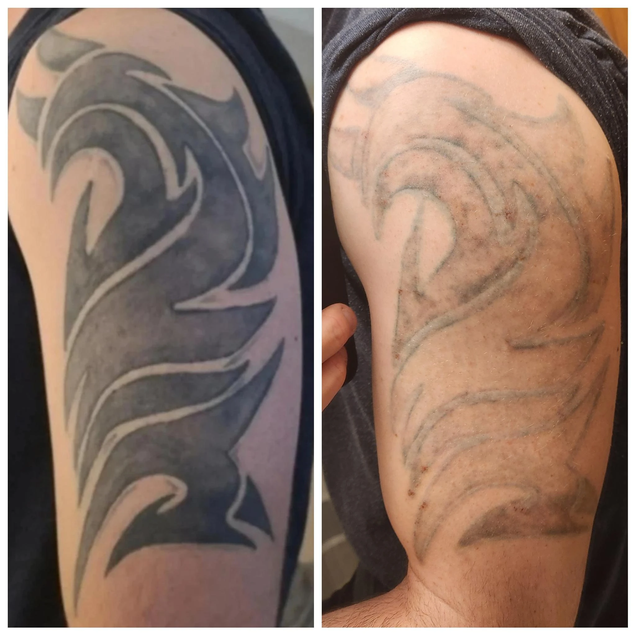 black tattoo before laser removal