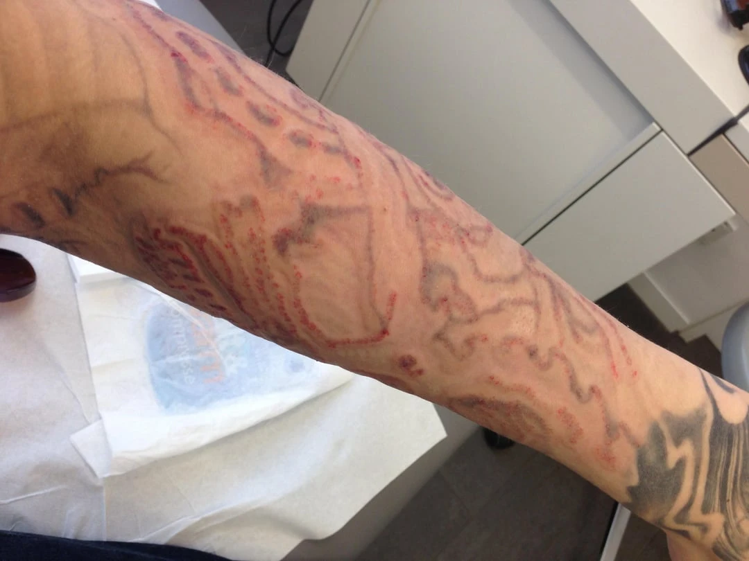 black tattoo after  sessions