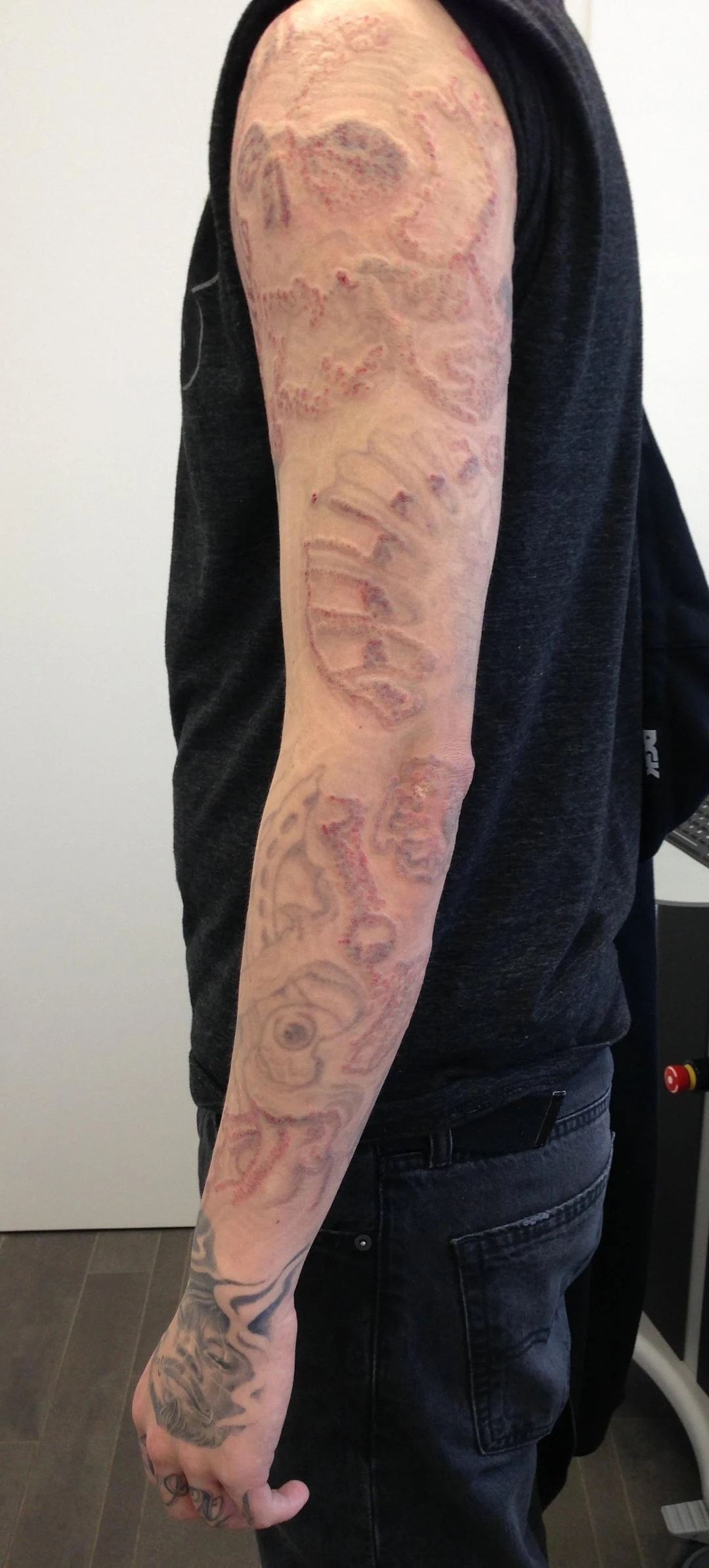 black tattoo before laser removal