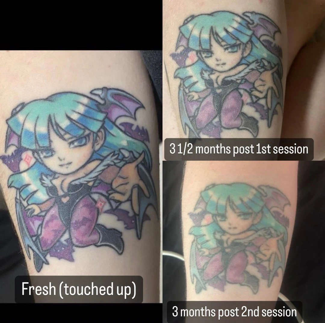 black tattoo before laser removal
