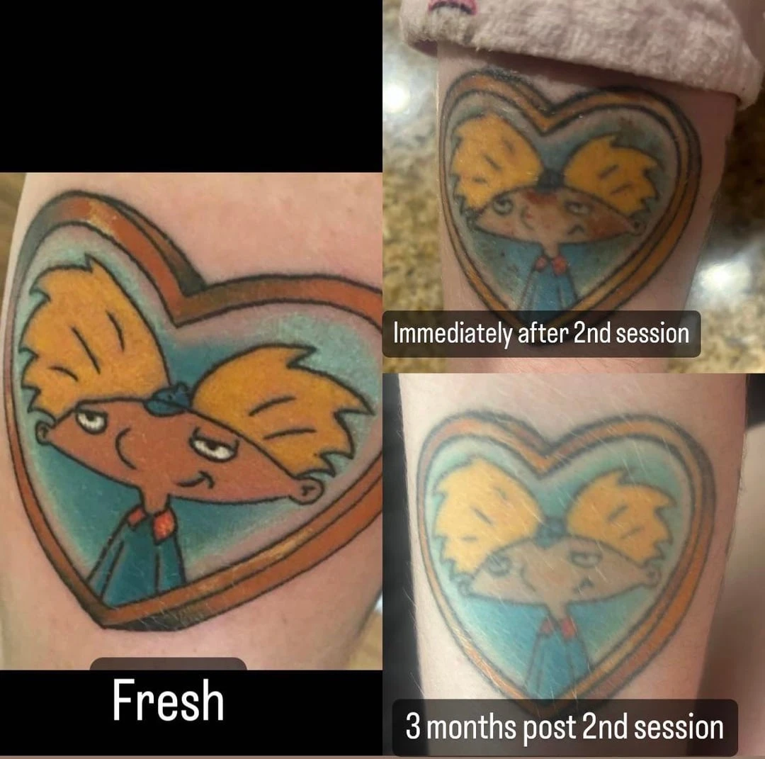 black tattoo after 2 sessions