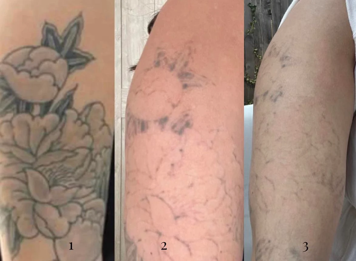 black tattoo before laser removal