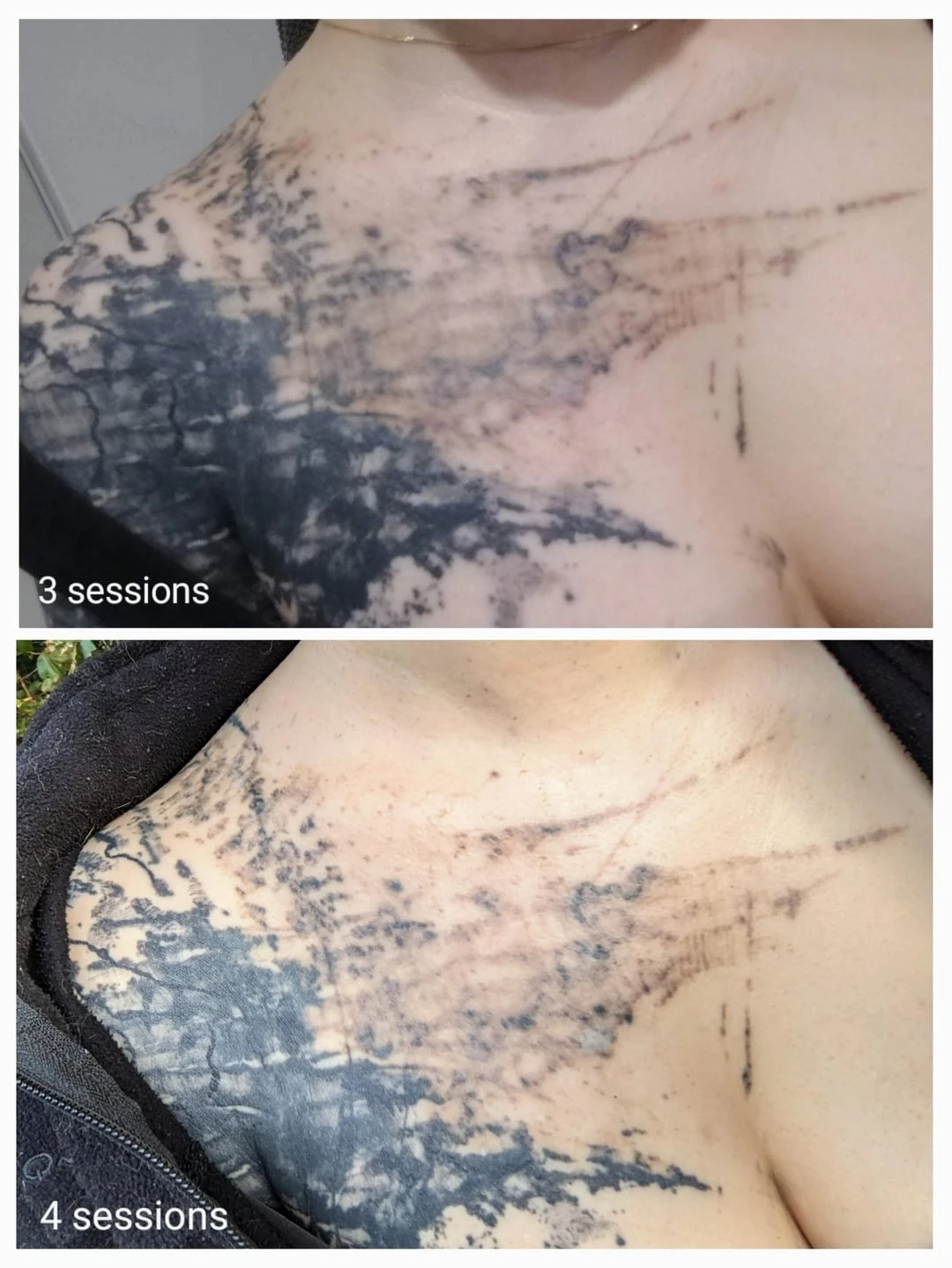 black tattoo before laser removal