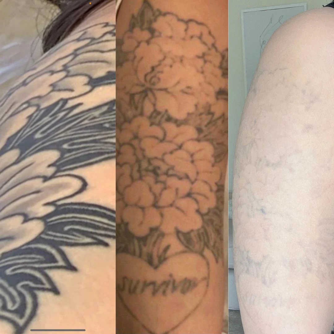 black and blue tattoo before laser removal