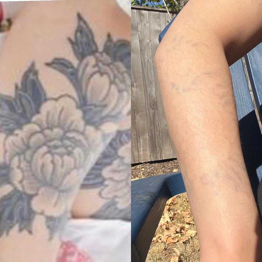 black tattoo before laser removal
