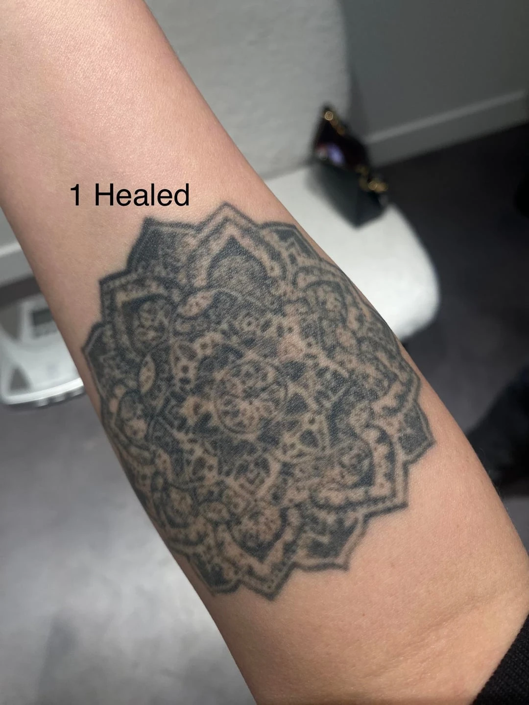 Black tattoo session 2 laser tattoo removal