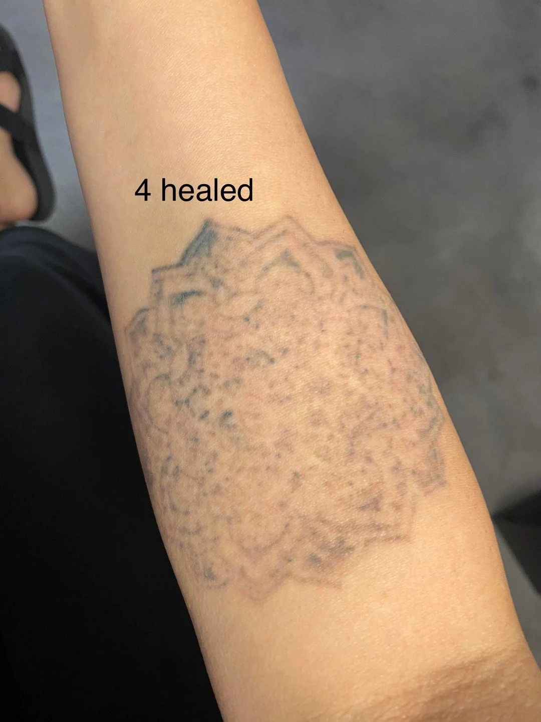 Medium Black Tattoo: 50% Fading After 5 Sessions at Rosenberg Plastic Surgery