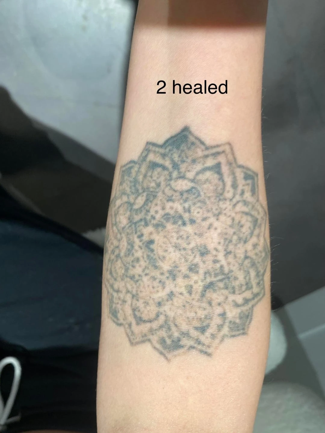 Black tattoo session 3 laser tattoo removal