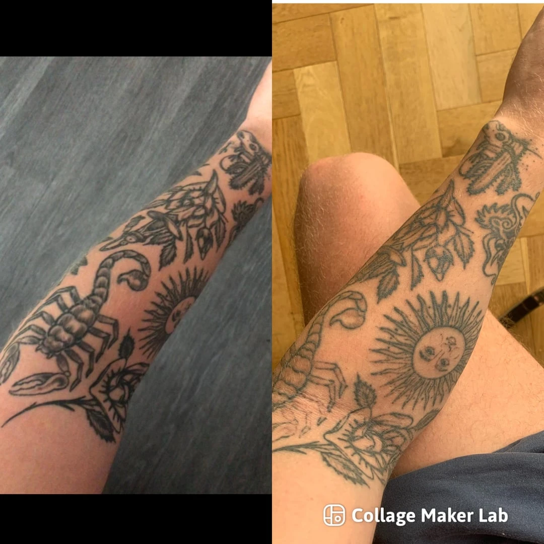 black tattoo before laser removal