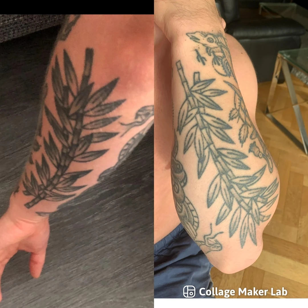 black tattoo after 5 sessions
