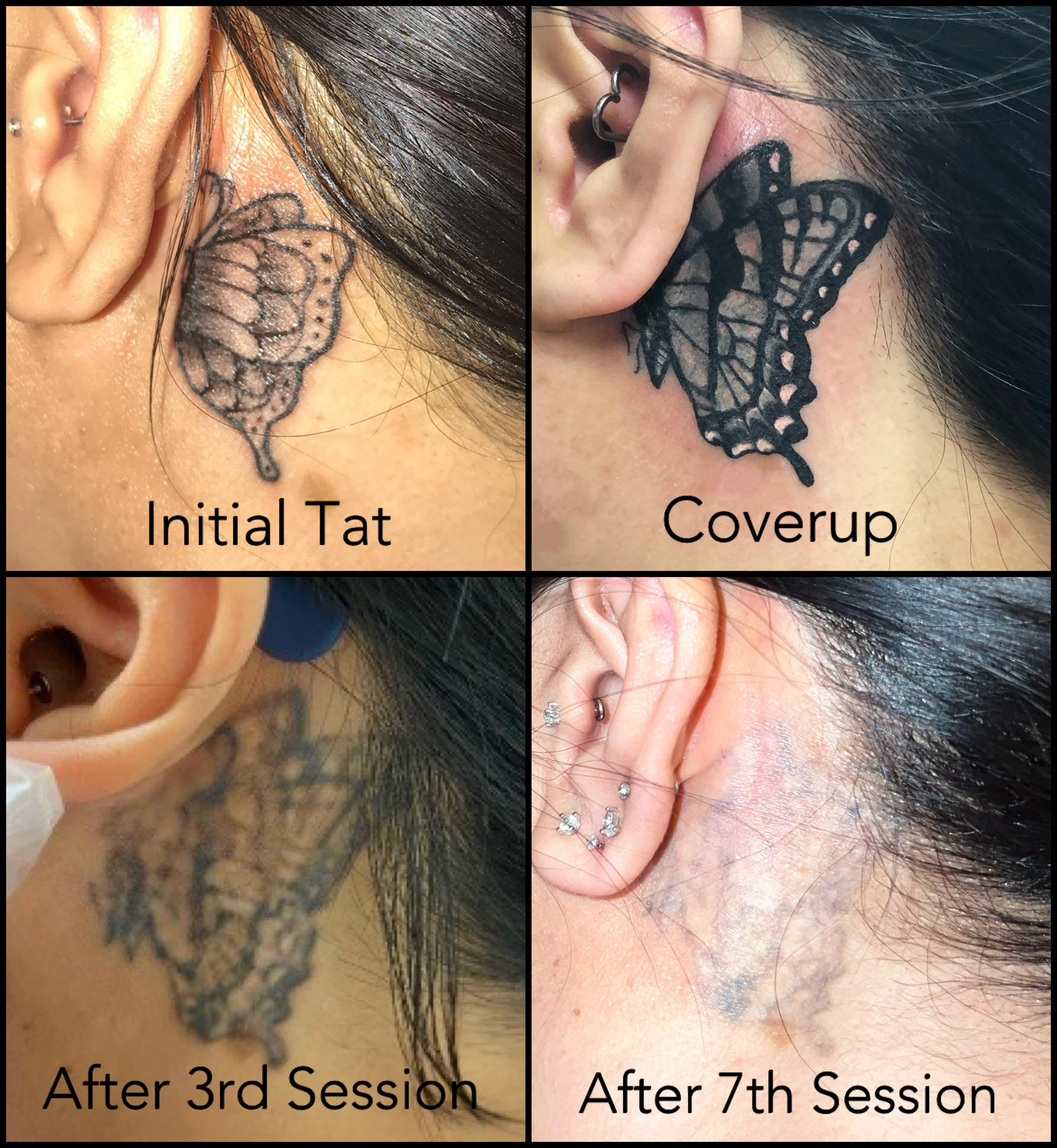 black tattoo before laser removal