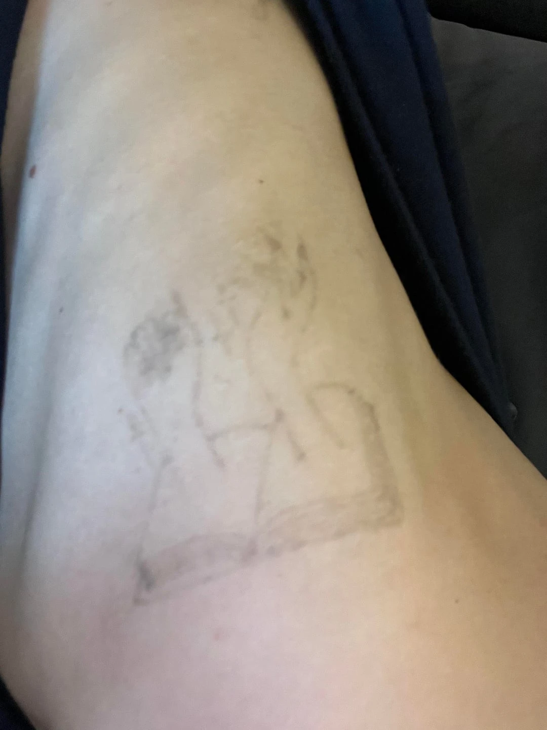 Black tattoo after 3 sessions