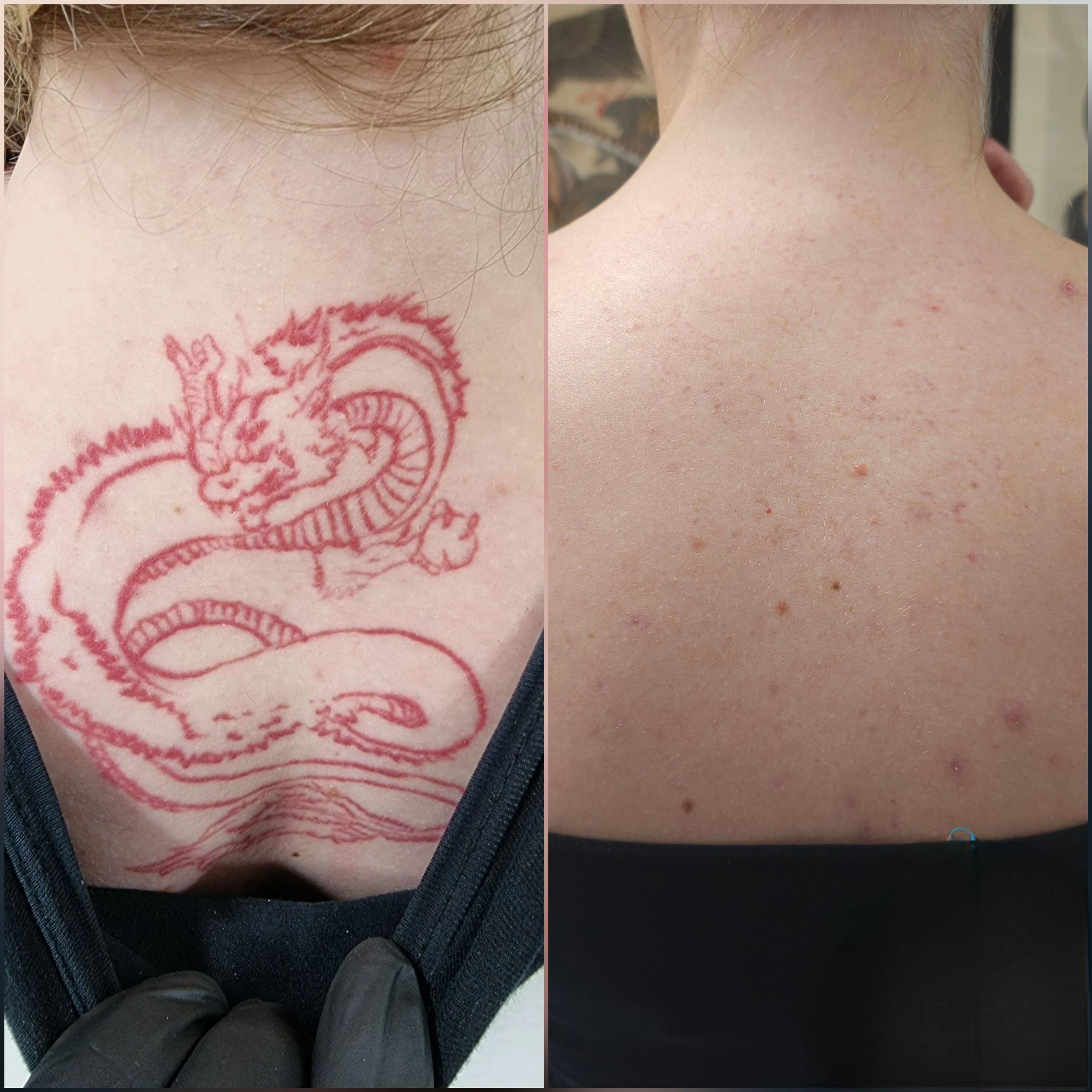 red tattoo before laser removal