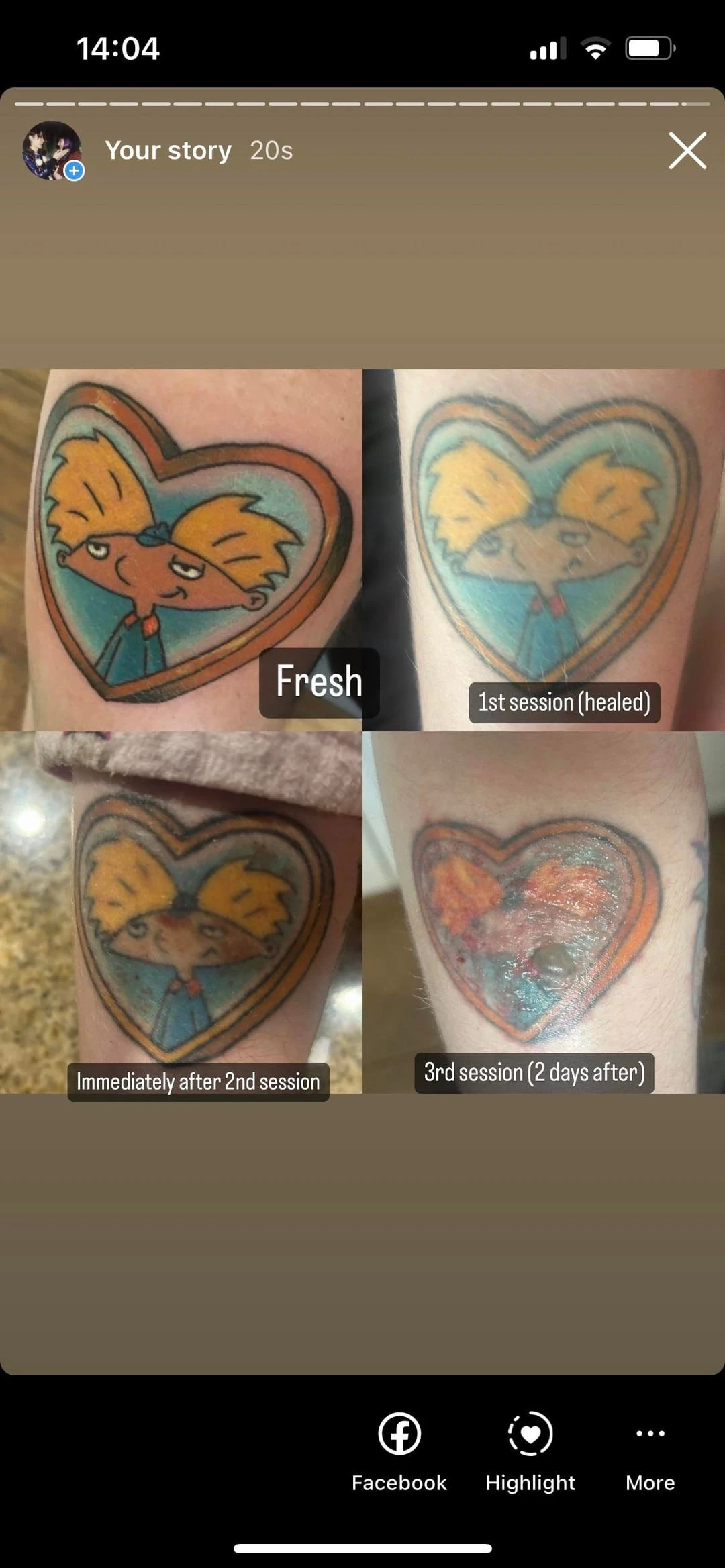 black tattoo after 3 sessions