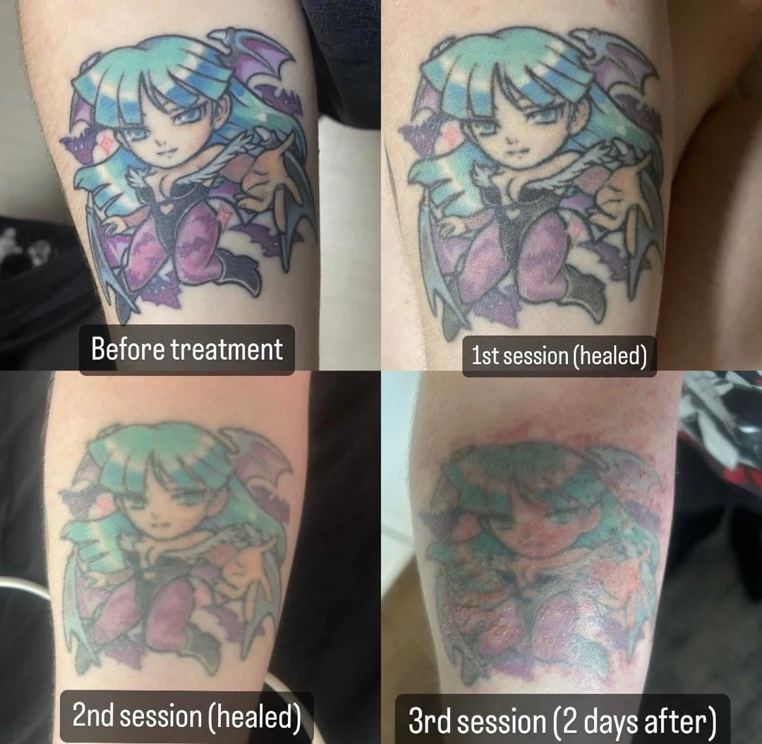 black tattoo before laser removal