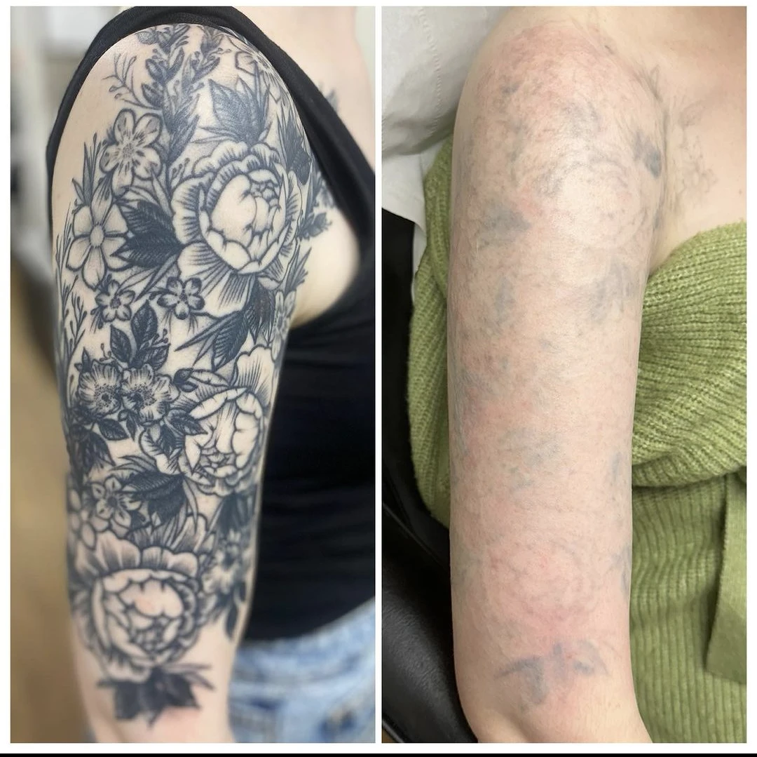 black tattoo before laser removal