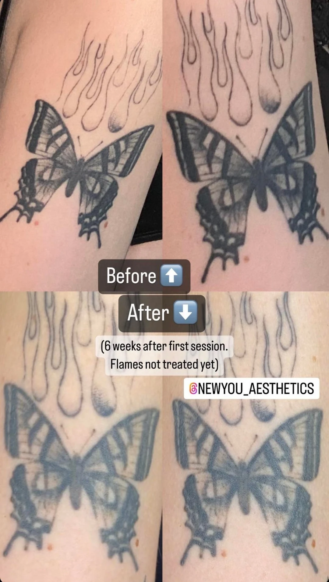 Black Tattoo on the Upper Arm, Lower Torso, Upper Torso, Shoulder After 3 Sessions: Minimal Visible Change So Far (25% Fading)